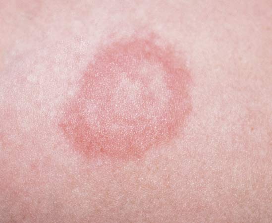 Bullseye Rash Itchy Lyme Disease Rashes And Look Alikes Lyme