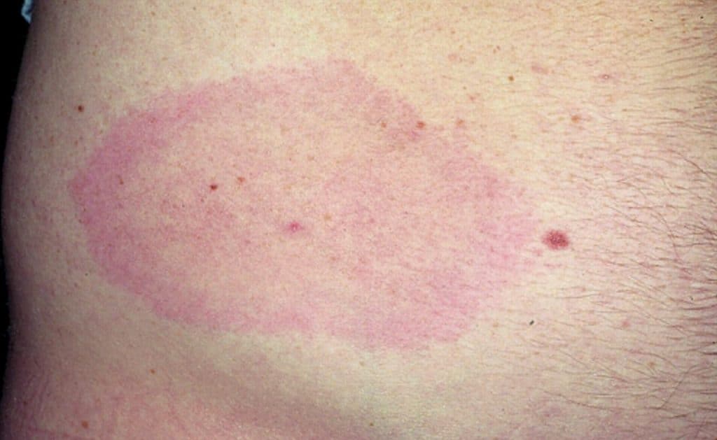 Bullseye Rash On Dog Belly - Dog Rash On Groin Pictures - atopic ...