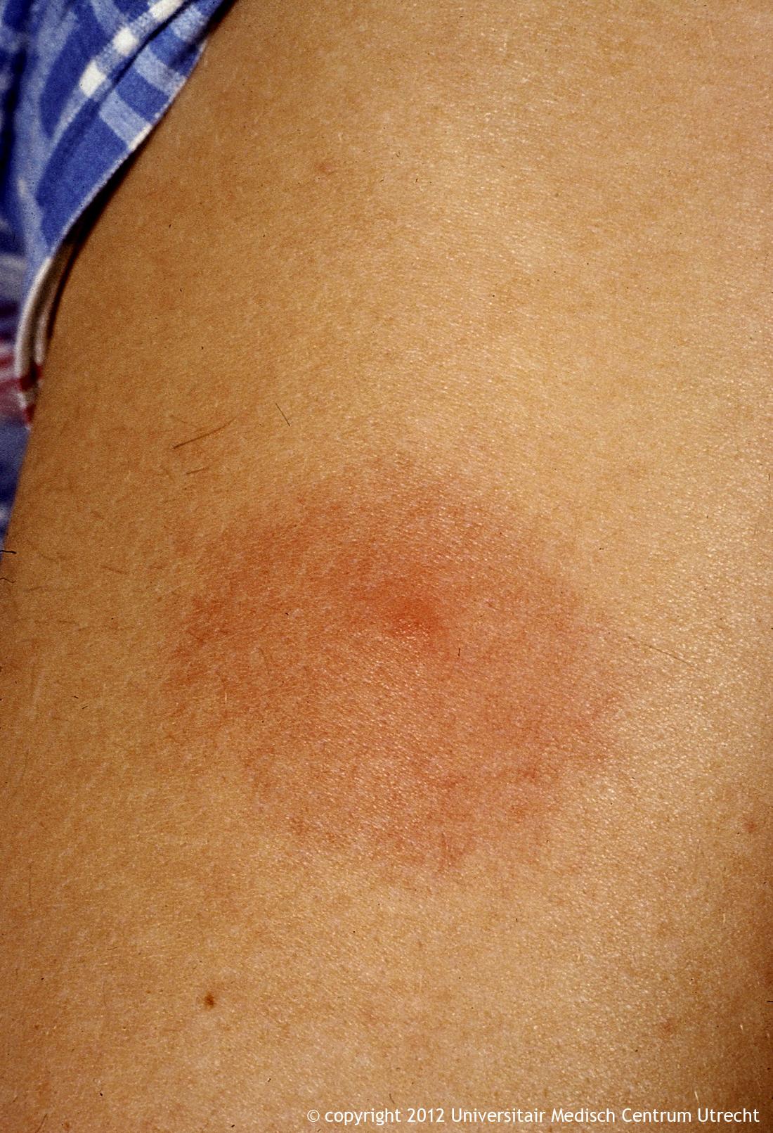 The Characteristic Bullseye Rash For Lyme Disease Innatoss