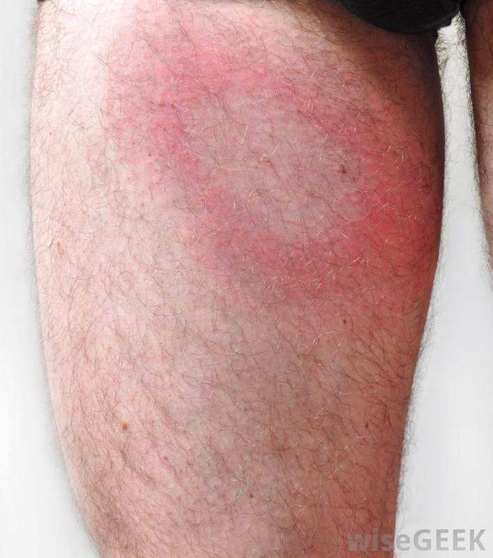 The Characteristic Bullseye Rash For Lyme Disease Innatoss